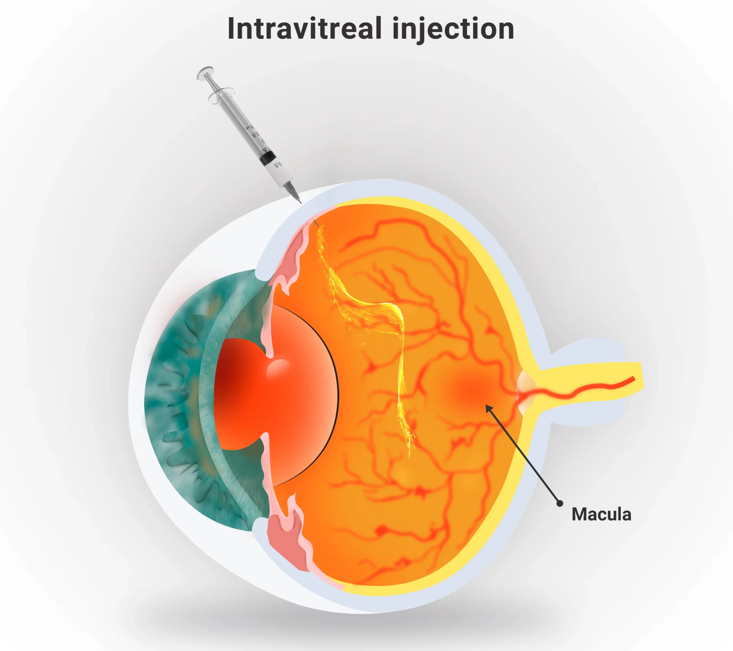 IVT Intravitreal Injection - Surgeries - Ophthalmo Obernai