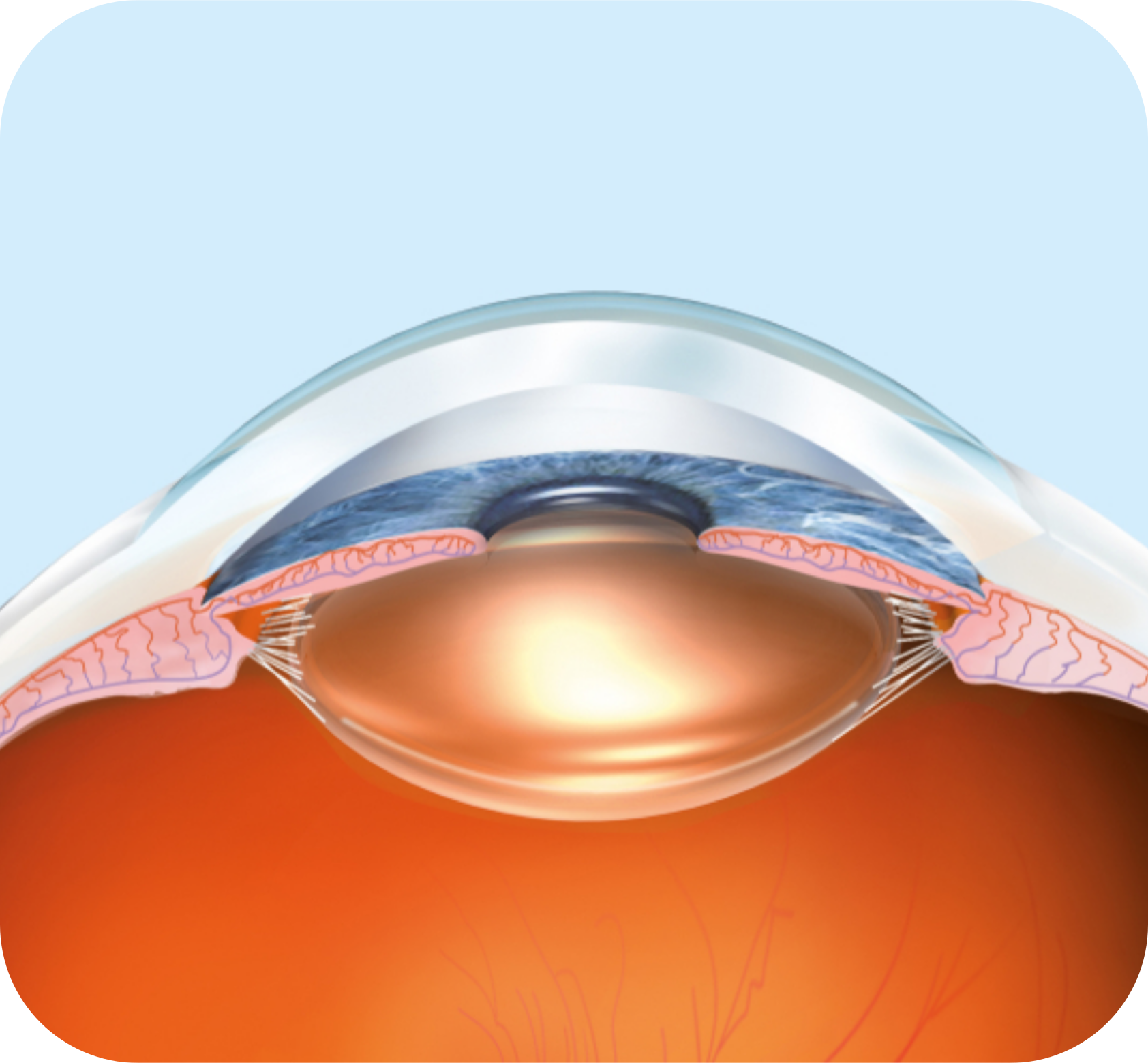 Traitement-chirurgical-Cataracte-Ophtalmo-Obernai